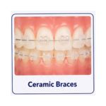 Ceramic braces with clear tooth-coloured brackets on teeth
