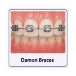 Damon braces with smaller self-ligating brackets on teeth
