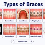Horizontal infographic showing different types of dental braces including metal braces, ceramic braces, lingual braces, self-ligating braces, Damon braces, clear aligners, sapphire braces, gold braces, power chain braces, and retainers with labelled close-up images and vocabish.com branding on a white background