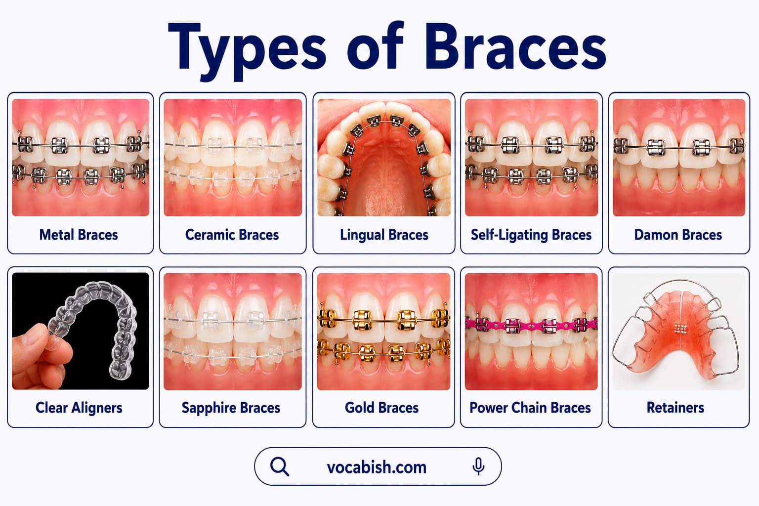 Horizontal infographic showing different types of dental braces including metal braces, ceramic braces, lingual braces, self-ligating braces, Damon braces, clear aligners, sapphire braces, gold braces, power chain braces, and retainers with labelled close-up images and vocabish.com branding on a white background