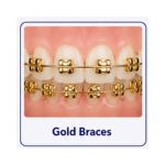 Gold braces with shiny gold-coloured brackets and wires