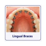 Lingual braces attached behind the teeth for hidden orthodontic treatment