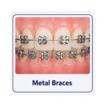 Metal braces with silver brackets and wires on straightened teeth