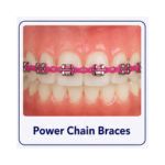 Power chain braces with colourful elastic chains connected across brackets