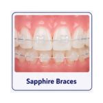 Sapphire braces with crystal-clear transparent brackets on teeth