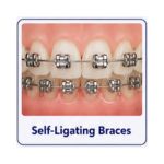 Self-ligating braces with modern clip brackets and metal wire