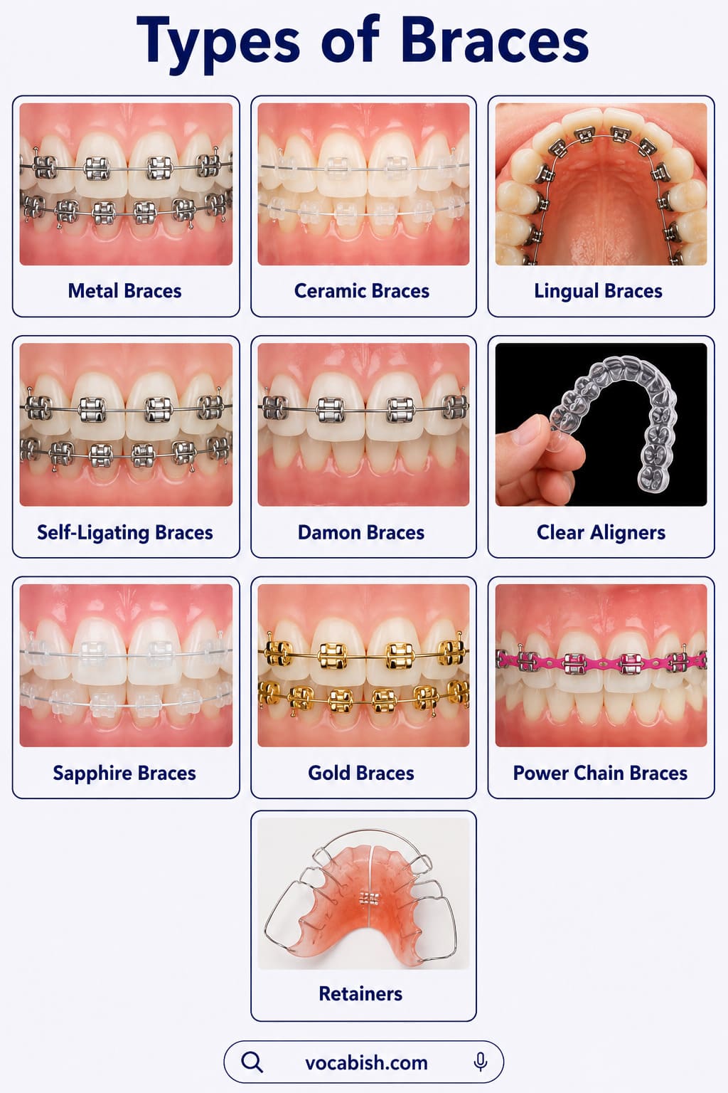 Educational infographic showing different types of dental braces including metal braces, ceramic braces, lingual braces, self-ligating braces, Damon braces, clear aligners, sapphire braces, gold braces, power chain braces, and retainers